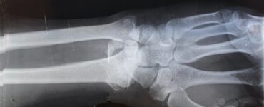 kako_postupiti_kod_prijeloma_kosti_ruke_prva_pomoc